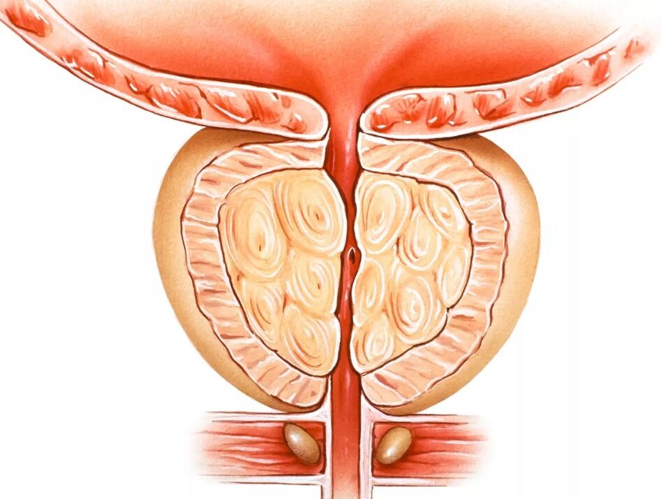 prostatitis