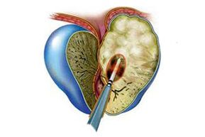 Symptoms of acute prostatitis
