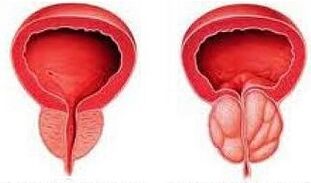 Healthy prostate and inflammation